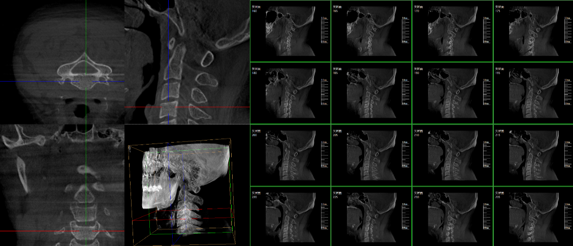 PLX7500三維c型臂脊柱外科臨床應(yīng)用圖像 PLX7500三維c型臂脊柱外科臨床應(yīng)用圖像