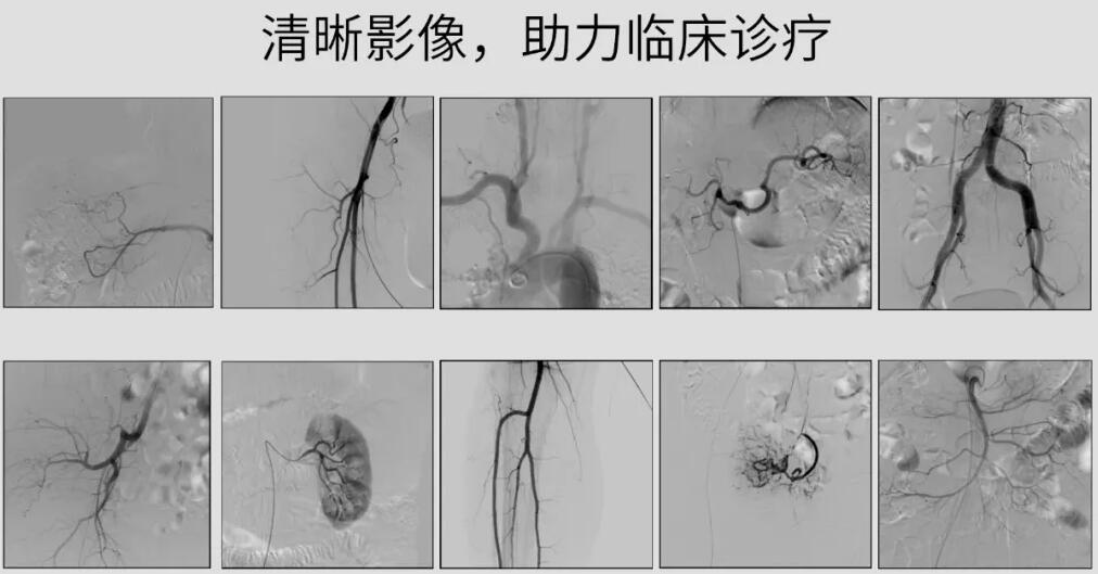 介入c臂機高清影像 介入c臂機高清影像