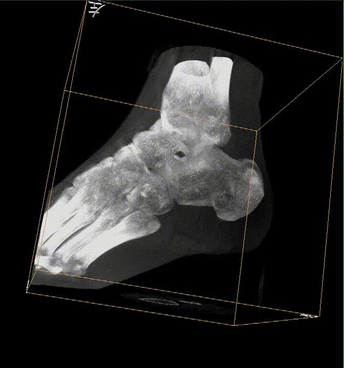 【醫療科普】之為什么說踝關節骨折手術復雜? 【醫療科普】之為什么說踝關節骨折手術復雜?