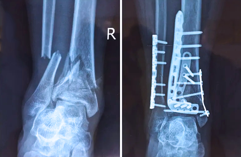 【醫療科普】:關節內的骨折 【醫療科普】:關節內的骨折