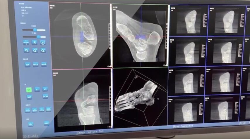 【醫療科普】:踝關節三維掃描 【醫療科普】:踝關節三維掃描