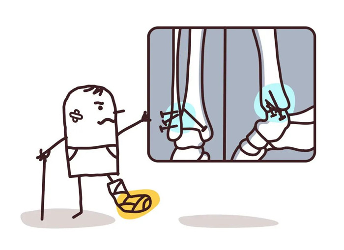 【醫(yī)療科普】：關節(jié)面不能有塌陷