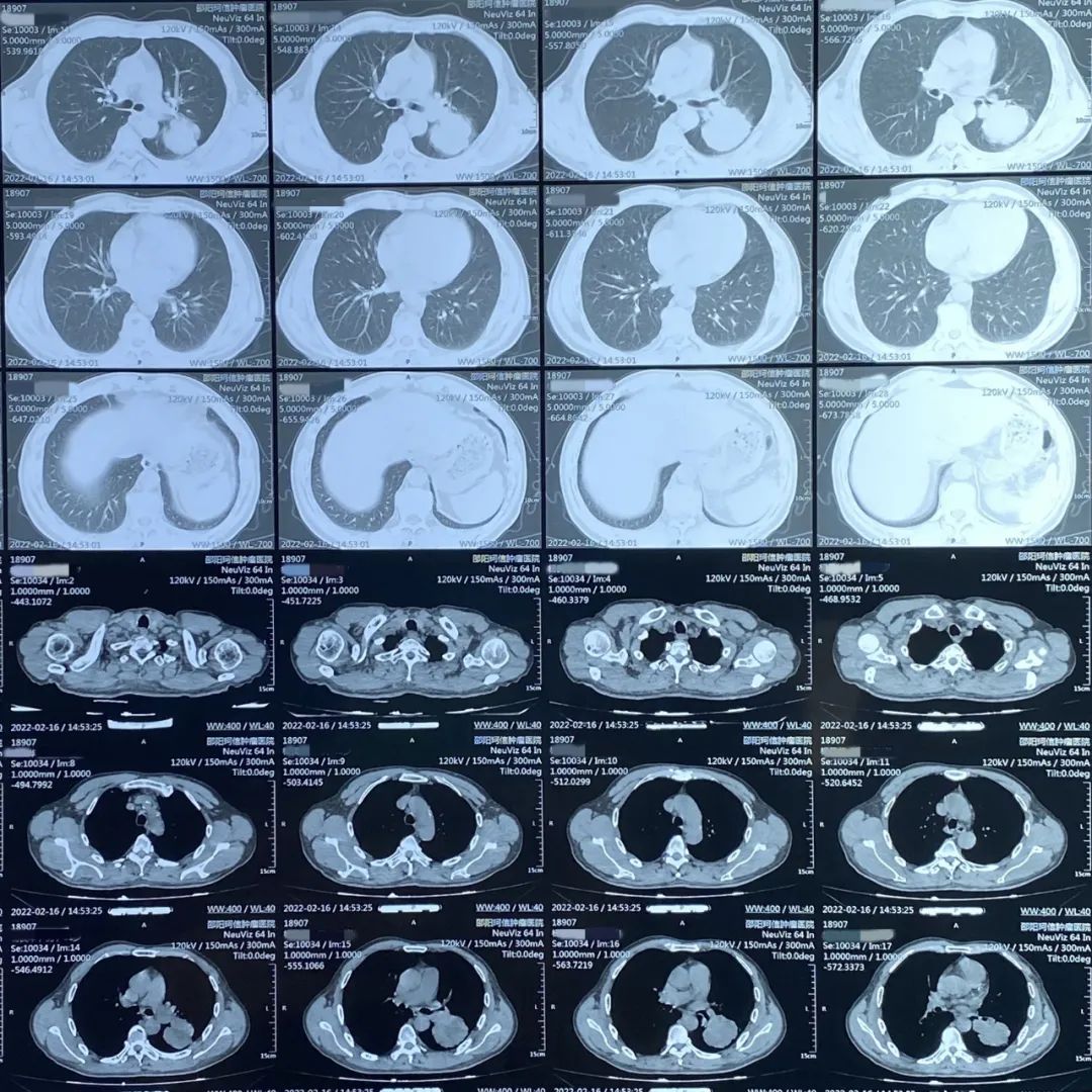 肺部CT診斷 肺部CT診斷