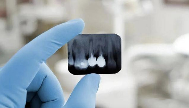 牙片機影像 牙片機影像