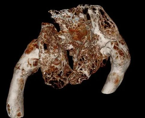 【醫(yī)療科普】:病理性骨折影像 【醫(yī)療科普】:病理性骨折影像