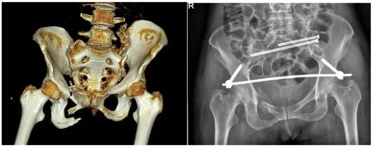 【醫(yī)療科普】:不穩(wěn)定性骨折影像 【醫(yī)療科普】:不穩(wěn)定性骨折影像