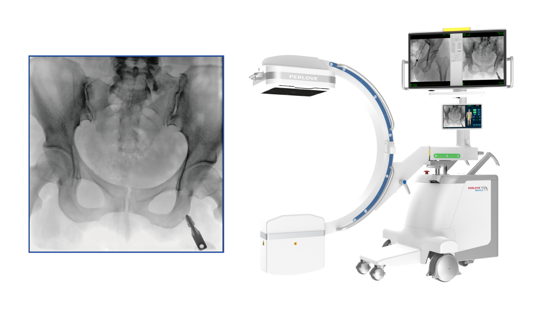 【醫(yī)療科普】:大尺寸平板C形臂提供更多圖像細節(jié) 【醫(yī)療科普】:大尺寸平板C形臂提供更多圖像細節(jié)