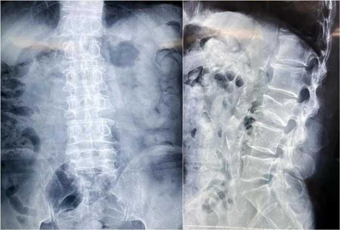 大平板C臂機-術前影像 大平板C臂機-術前影像