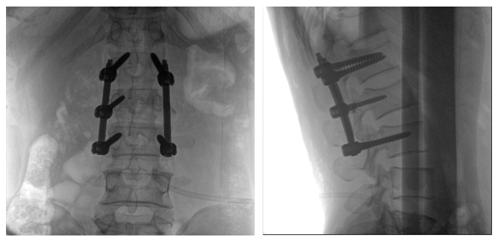 一體式C形臂全節段腰椎臨床影像 一體式C形臂全節段腰椎臨床影像