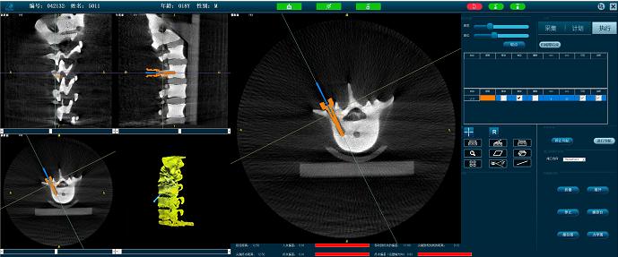 骨科手術(shù)機(jī)器人導(dǎo)航 骨科手術(shù)機(jī)器人導(dǎo)航