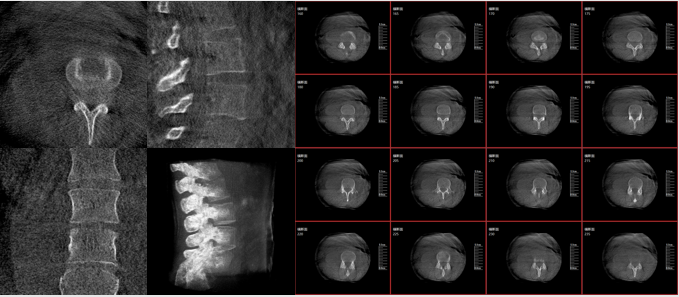 術(shù)中三維C臂的優(yōu)勢(shì):三維影像功能 術(shù)中三維C臂的優(yōu)勢(shì):三維影像功能