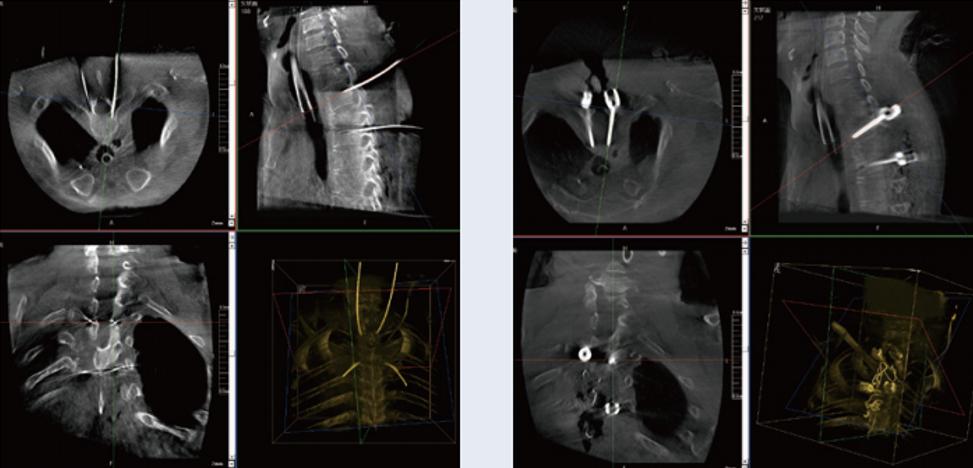 三維C臂與骨科導(dǎo)航機器人配合應(yīng)用(助力骨科手術(shù)更準確) 三維C臂與骨科導(dǎo)航機器人配合應(yīng)用(助力骨科手術(shù)更準確)