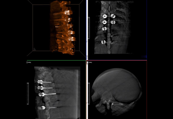 術中三維導航C臂影像 術中三維導航C臂影像