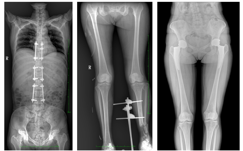 數字化X光機影像 數字化X光機影像