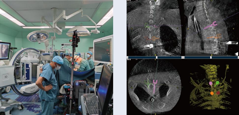 術(shù)中三維C形臂影像在脊柱導(dǎo)航機器人系統(tǒng)中的應(yīng)用 術(shù)中三維C形臂影像在脊柱導(dǎo)航機器人系統(tǒng)中的應(yīng)用