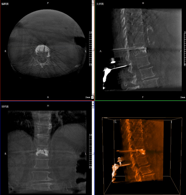 骨科機器人影像 骨科機器人影像