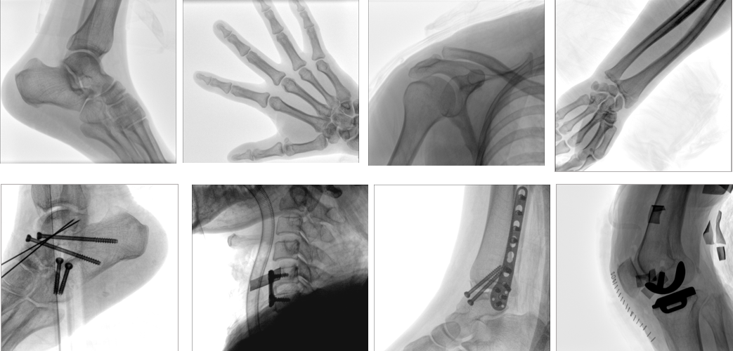 移動式平板C形臂X射線機(jī)臨床影像
